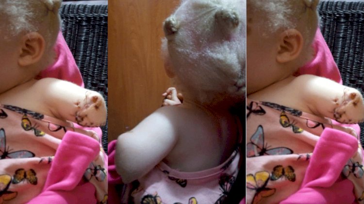 Zambia: Criminals in Kitwe Hack Off The Hand Of 7 Year-Old Girl With Albinism